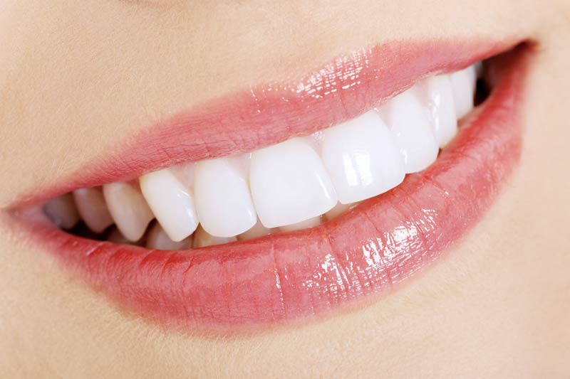 Porcelain Veneers in Haverhill