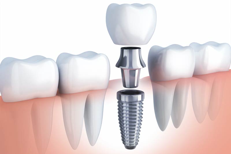 Dental Implants in Haverhill